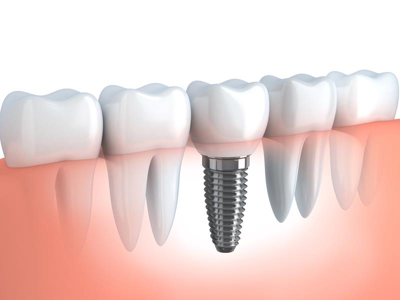 Dental Implants  Great Falls, VA 